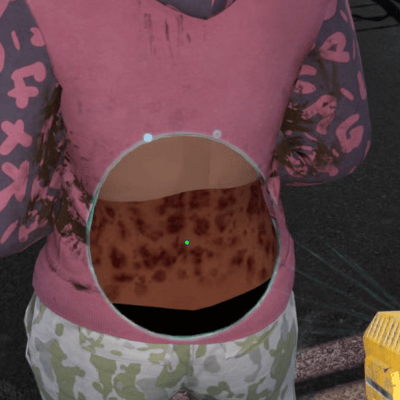 Herpes